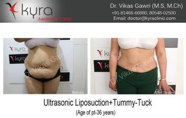 ABDOMINOPLASTY