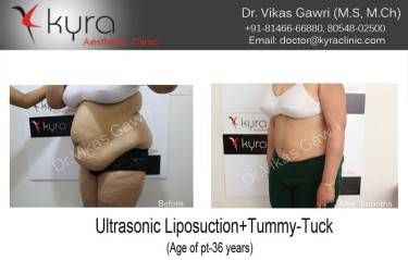 ABDOMINOPLASTY