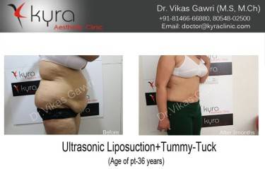 ABDOMINOPLASTY