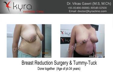 BREAST REDUCTION