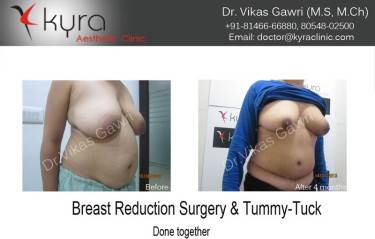 ABDOMINOPLASTY