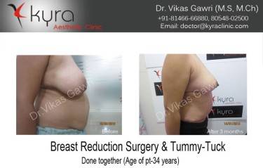 ABDOMINOPLASTY