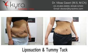 ABDOMINOPLASTY