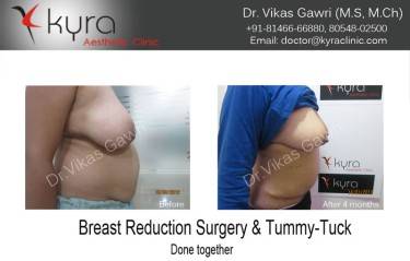 ABDOMINOPLASTY