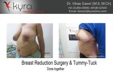 BREAST REDUCTION