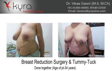 BREAST REDUCTION
