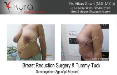 ABDOMINOPLASTY