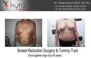 ABDOMINOPLASTY