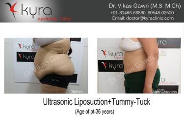 ABDOMINOPLASTY