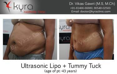 ABDOMINOPLASTY