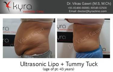 ABDOMINOPLASTY