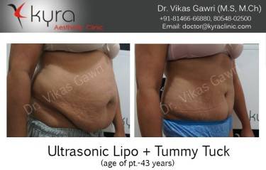 ABDOMINOPLASTY