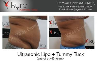 ABDOMINOPLASTY