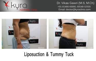 ABDOMINOPLASTY