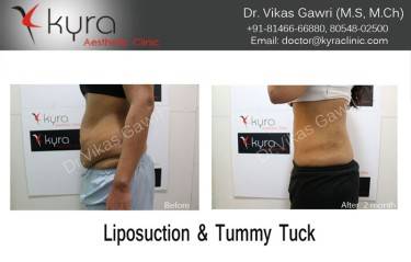 ABDOMINOPLASTY