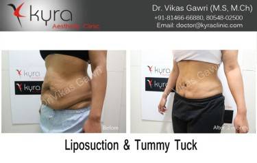 ABDOMINOPLASTY
