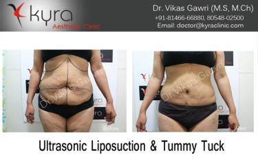 ABDOMINOPLASTY