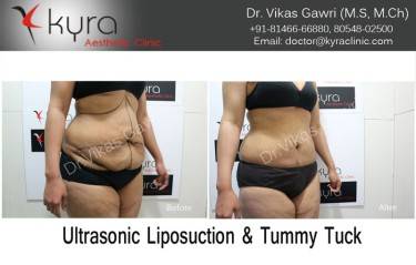 ABDOMINOPLASTY