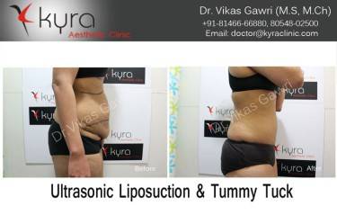 ABDOMINOPLASTY