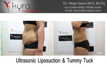 ABDOMINOPLASTY