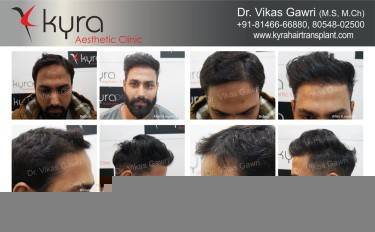Scalp Hair Transplant