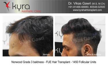 Scalp Hair Transplant
