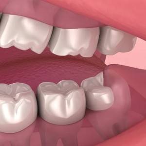 Dental-Crowns
